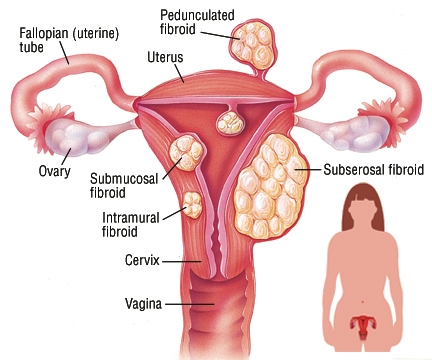uterine fibroids treatment brooklyn ny