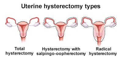 Uterine Hysterectomy
